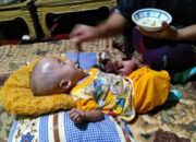 Balita Penderita Hidrosefalus, Kondisinya Membaik