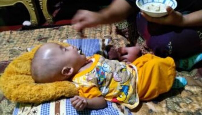 Balita Penderita Hidrosefalus, Kondisinya Membaik