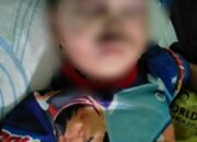 Di Cipedes, Wajah Anak Penuh Luka Bakar Akibat Petasan