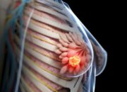 Kemenkes Akui Kekurangan Dokter untuk Tangani Kanker Payudara