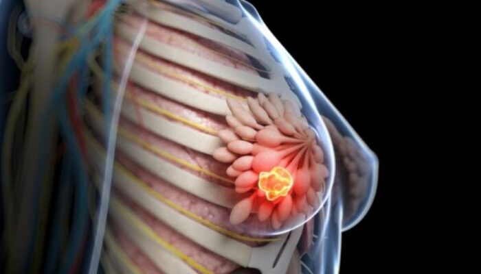 Kemenkes Akui Kekurangan Dokter untuk Tangani Kanker Payudara
