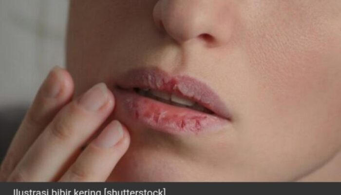 Tips Atasi Bibir Pecah-Pecah, Bisa Dilakukan di Rumah