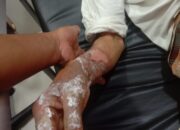 Seorang Kakek Tersengat Listrik, Kulit Tangannya Melepuh