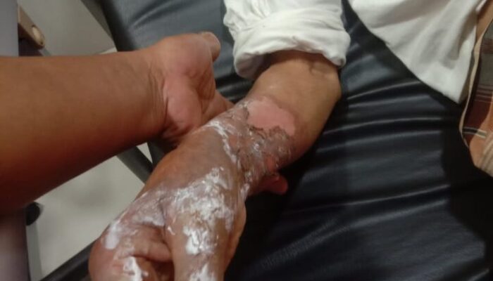 Seorang Kakek Tersengat Listrik, Kulit Tangannya Melepuh
