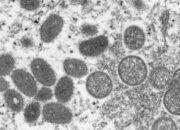 Waspadai Potensi Penyebaran Virus Cacar Monyet, Ini Gejalanya