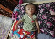 Askyla Balita Penderita Hidrosefalus di Bandung yang Tak Tersentuh Bantuan Pemerintah