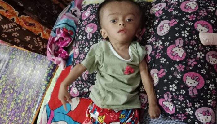 Askyla Balita Penderita Hidrosefalus di Bandung yang Tak Tersentuh Bantuan Pemerintah