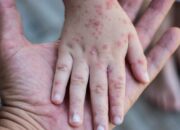 Waspada! 3 Warga Jabar Terinfeksi Cacar Monyet